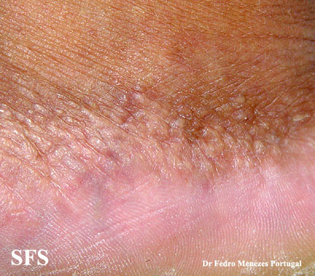 Acrokeratoelastoidosis (Dermatology Atlas 4).jpg