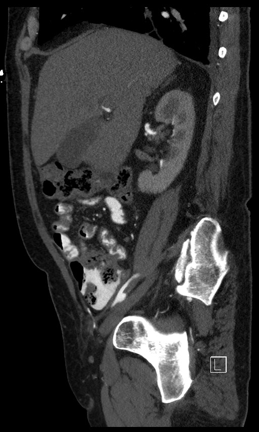Active lower gastrointestinal bleeding - diverticular (Radiopaedia 61203-69106 Sagittal C+ arterial phase 109).jpg