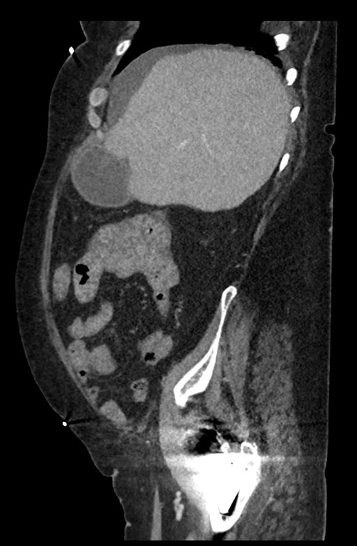Active renal extravasation with large subcapsular and retroperitoneal hemorrhage (Radiopaedia 60975-68796 Sagittal C+ portal venous phase 167).jpg