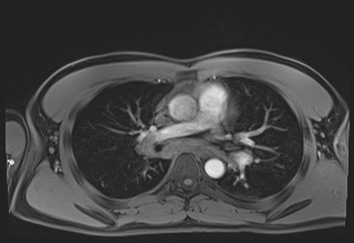 Active right ventricular cardiac sarcoidosis (Radiopaedia 55596-62100 Axial Post contrast Dixon 28).jpg