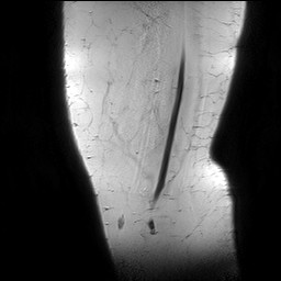 Acute-on-chronic transient lateral patellar dislocation with trochlear dysplasia (Radiopaedia 84099-99349 Sagittal PD 1).jpg