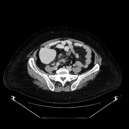 Acute appendicitis, heterotaxy syndrome (Radiopaedia 66884-76202 Axial C+ portal venous phase 90).jpg