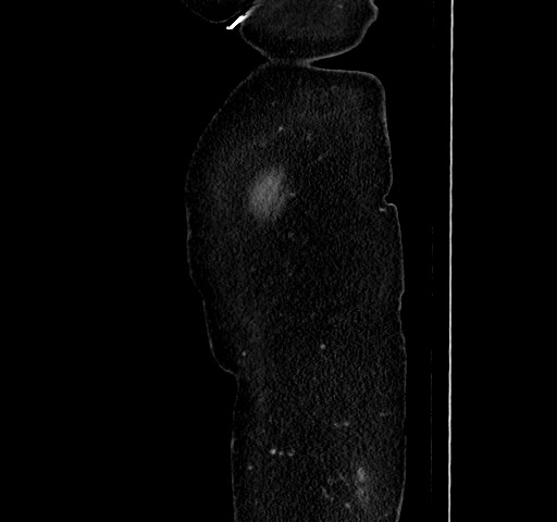 File:Acute appendicitis, heterotaxy syndrome (Radiopaedia 66884-76202 Sagittal C+ portal venous phase 13).jpg