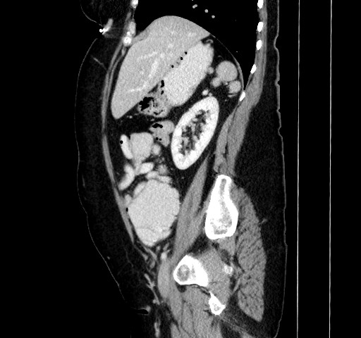 Acute appendicitis, heterotaxy syndrome (Radiopaedia 66884-76202 Sagittal C+ portal venous phase 48).jpg