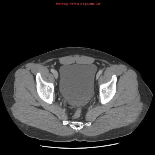File:Acute appendicitis (Radiopaedia 10498-10973 Axial C+ portal venous phase 53).jpg