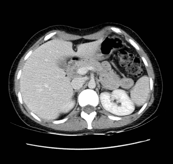 Acute appendicitis (Radiopaedia 22892-22918 Axial C+ portal venous phase 23).png
