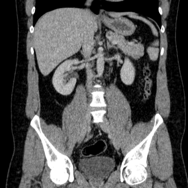 Acute appendicitis (Radiopaedia 38255-40270 Coronal C+ portal venous phase 48).jpg