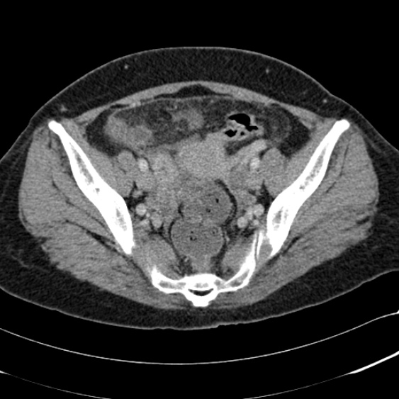 Acute appendicitis (Radiopaedia 48792-53822 Axial C+ portal venous phase 95).jpg