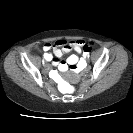 File:Acute appendicitis (Radiopaedia 52672-58589 Axial C+ arterial phase 24).jpg
