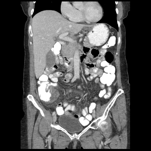 Acute appendicitis (Radiopaedia 52672-58589 Coronal C+ portal venous phase 36).jpg