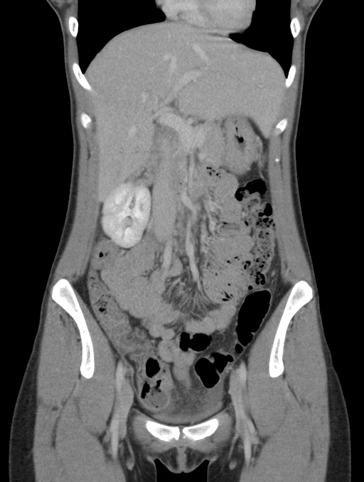 Acute appendicitis (Radiopaedia 62608-70901 Coronal C+ portal venous phase 15).jpg