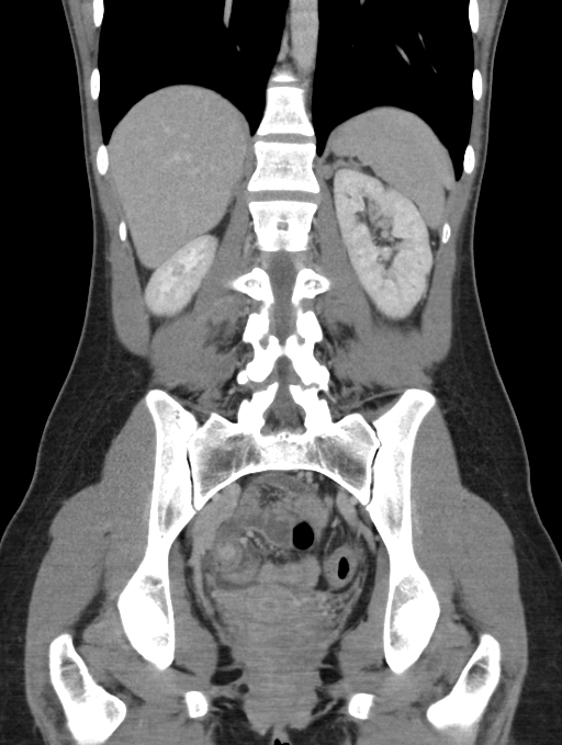 Acute appendicitis (Radiopaedia 62608-70901 Coronal C+ portal venous phase 38).jpg