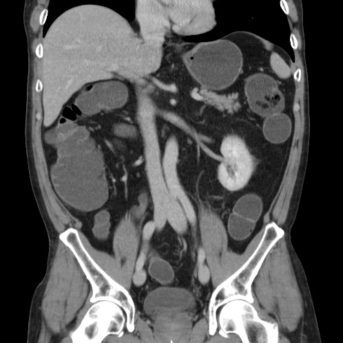 Acute appendicitis (Radiopaedia 66513-75790 Coronal C+ portal venous phase 39).jpg