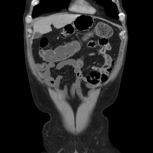 Acute appendicitis (Radiopaedia 66513-75790 Coronal C+ portal venous phase 5).jpg