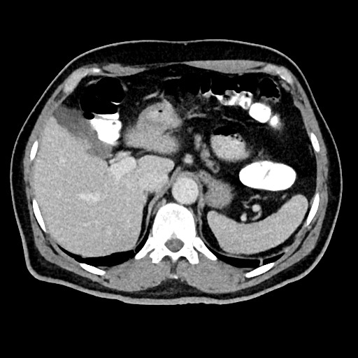 Acute appendicitis (Radiopaedia 77016-88960 Axial C+ portal venous phase 36).jpg