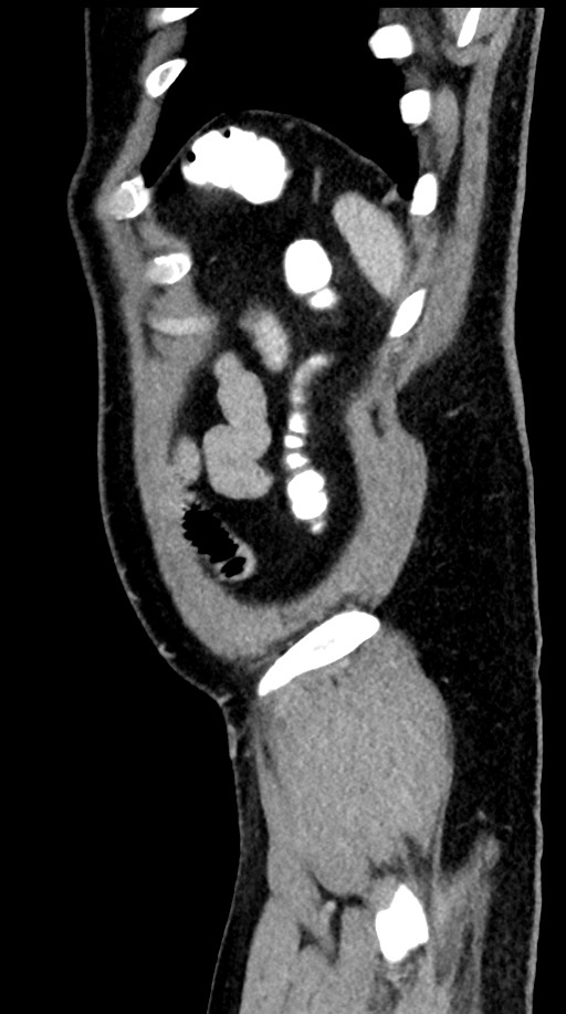 Acute appendicitis (Radiopaedia 77016-88960 Sagittal C+ portal venous phase 13).jpg