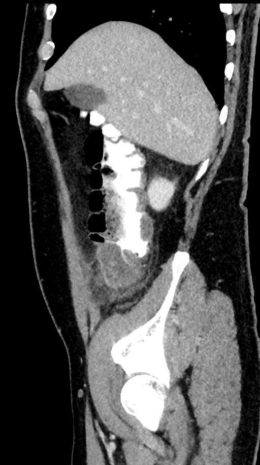 Acute appendicitis (Radiopaedia 77016-88960 Sagittal C+ portal venous phase 90).jpg