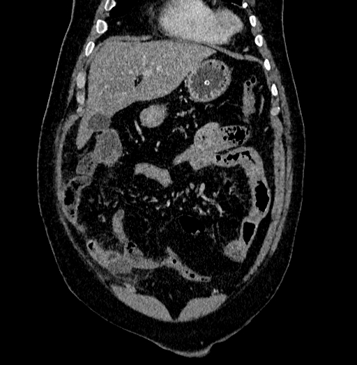 Acute appendicitis (Radiopaedia 79950-93224 Coronal C+ portal venous phase 22).jpg