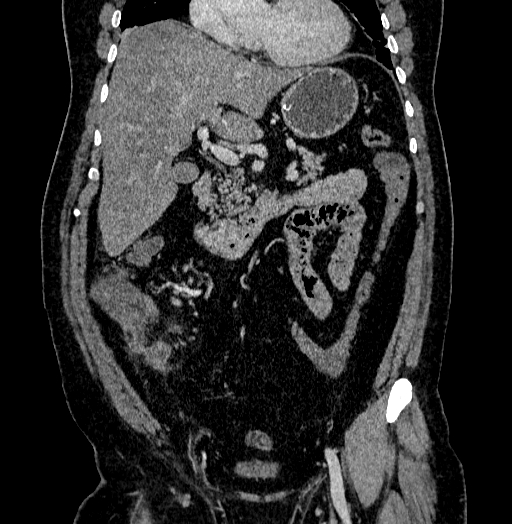 Acute appendicitis (Radiopaedia 79950-93224 Coronal C+ portal venous phase 39).jpg