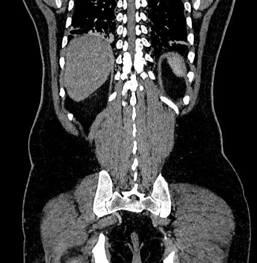 File:Acute appendicitis (Radiopaedia 79950-93224 Coronal C+ portal venous phase 78).jpg
