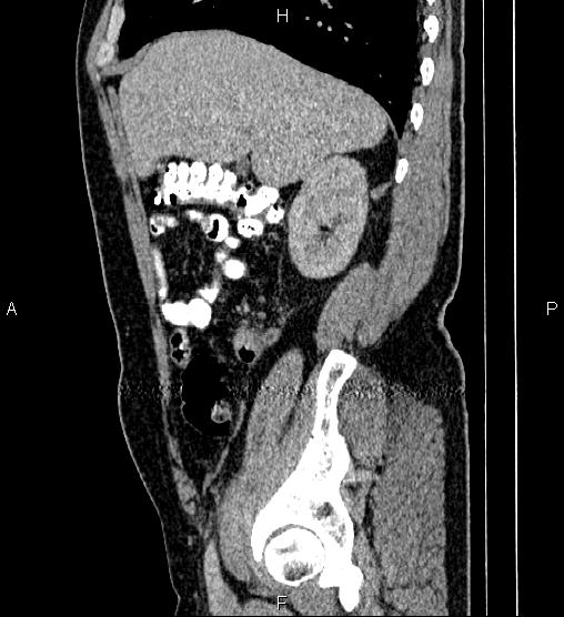 Acute appendicitis (Radiopaedia 84780-100240 Sagittal C+ portal venous phase 27).jpg