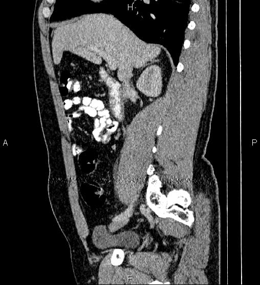 Acute appendicitis (Radiopaedia 84780-100240 Sagittal C+ portal venous phase 38).jpg