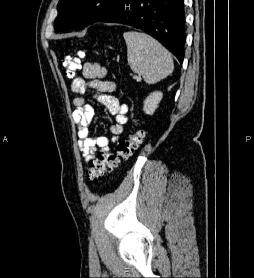 Acute appendicitis (Radiopaedia 84780-100240 Sagittal C+ portal venous phase 87).jpg