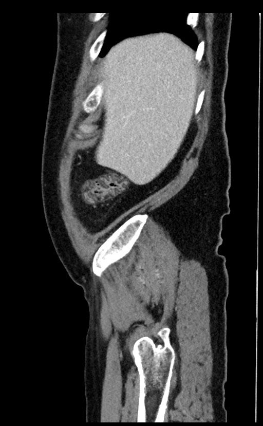Acute appendicitis - large appendicoliths (Radiopaedia 61805-69820 Sagittal C+ portal venous phase 101).jpg