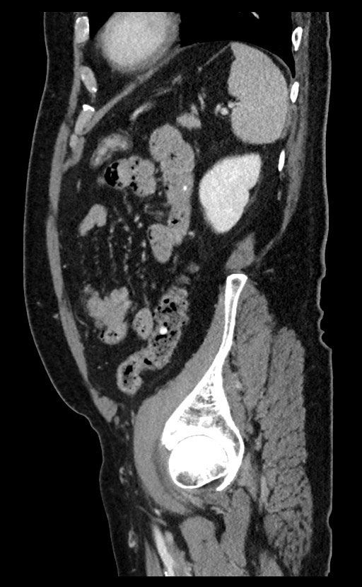 Acute appendicitis - large appendicoliths (Radiopaedia 61805-69820 Sagittal C+ portal venous phase 28).jpg