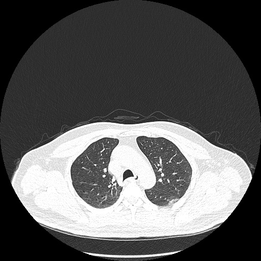 Acute appendicitis and COVID 19 pneumonia (Radiopaedia 76604-88380 Axial lung window 18).jpg