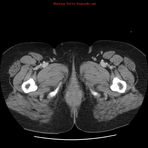 Acute appendicitis complicated by ovarian vein thrombophlebitis (Radiopaedia 16172-15851 Axial C+ portal venous phase 95).jpg