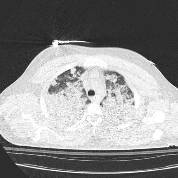 Acute aspiration pneumonitis (Radiopaedia 33605-34703 Axial lung window 27).jpg