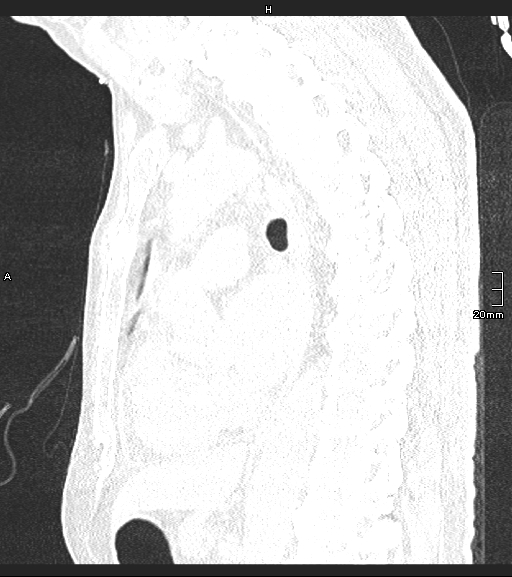 Acute aspiration pneumonitis (Radiopaedia 55642-62166 Sagittal lung window 69).jpg