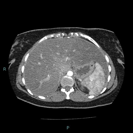 Acute bilateral pyelonephritis (Radiopaedia 37146-38881 Axial C+ arterial phase 28).jpg