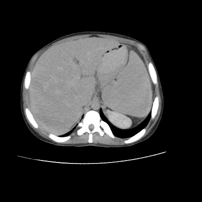 File:Acute calculous cholecystitis in patient with osteopetrosis (Radiopaedia 77871-90159 Axial C+ delayed 6).jpg