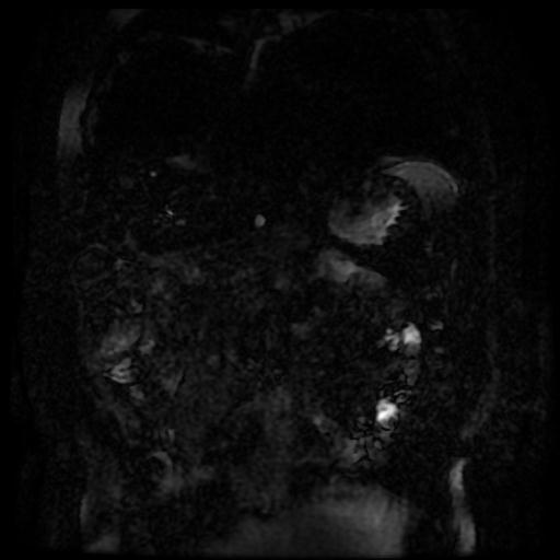 Acute cholecystitis and biliary hamartomas (Radiopaedia 86231-102240 E 138).jpg
