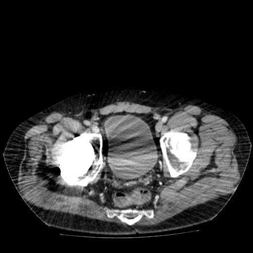 Acute cholecystitis and incidental left sided IVC (Radiopaedia 49352-54459 Axial C+ portal venous phase 142).jpg