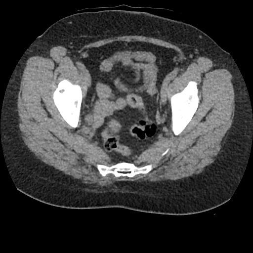 File:Acute cholecystitis and ureteric colic (Radiopaedia 42330-45444 Axial prone 95).jpg