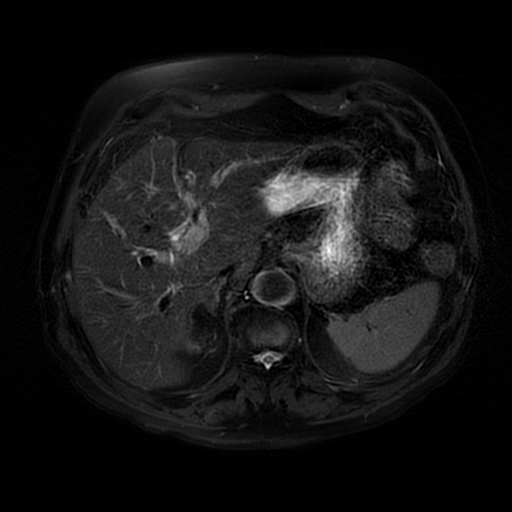 File:Acute cholecystitis complicated by pylephlebitis (Radiopaedia 65782-74915 Axial T2 fat sat 15).jpg