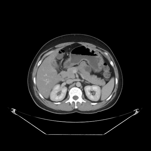 File:Acute complicated calculous cholecystitis (Radiopaedia 55202-61587 Axial C+ delayed 37).jpg