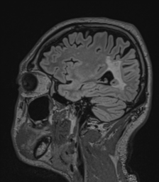 Acute disseminated encephalomyelitis (ADEM)- Anti-NMDA receptor encephalitis (Radiopaedia 54920-61201 Sagittal FLAIR 60).png