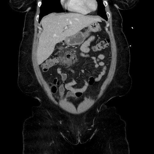 Acute diverticulitis - transverse colon (Radiopaedia 87063-103327 Coronal C+ portal venous phase 58).jpg
