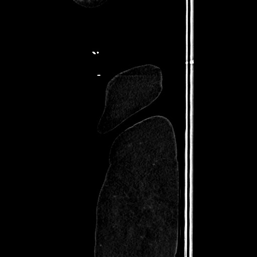 Acute diverticulitis - transverse colon (Radiopaedia 87063-103327 Sagittal C+ portal venous phase 224).jpg