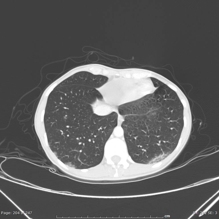 Acute eosinophilic pneumonia (Radiopaedia 48211-53073 Axial lung window 73).jpg