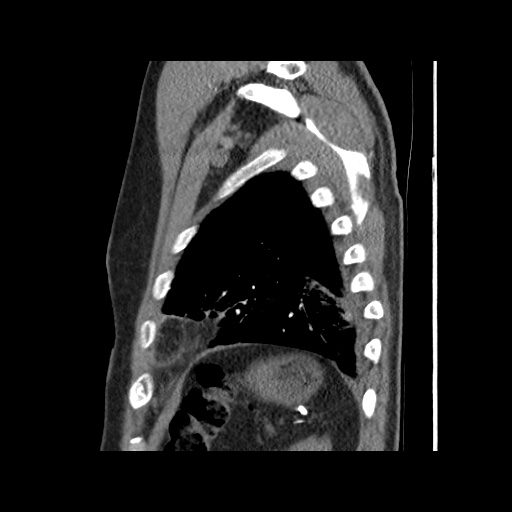 Acute epicardial fat necrosis (Radiopaedia 42327-45440 Sagittal C+ CTPA 59).jpg
