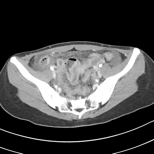 Acute gangrenous appendicitis with perforation (Radiopaedia 40152-42662 Axial C+ portal venous phase 58).png