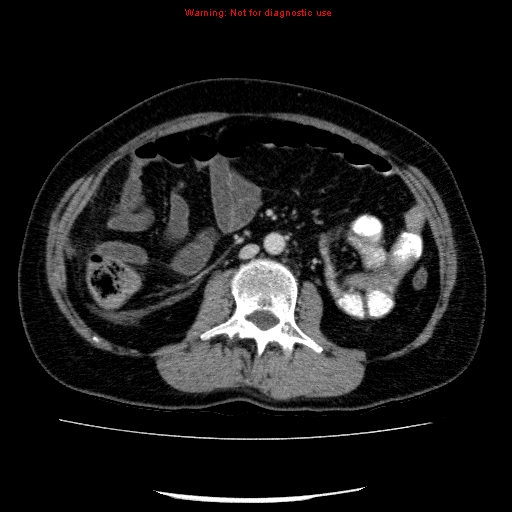 Acute gangrenous cholecystitis (Radiopaedia 10123-10661 Axial C+ portal venous phase 53).jpg