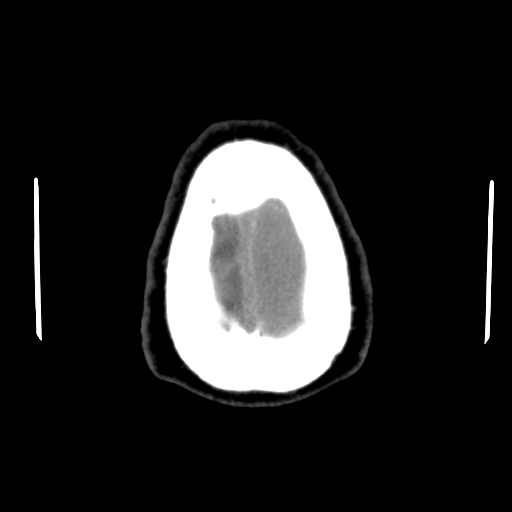 Acute hemorrhagic stroke (Radiopaedia 17507-17223 Axial non-contrast 48).jpg