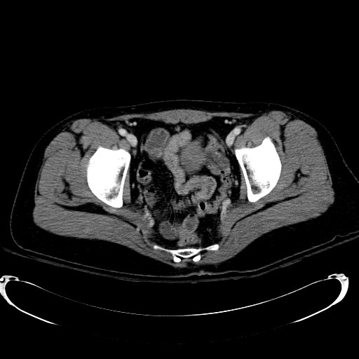 Acute myocardial infarction in CT (Radiopaedia 39947-42415 Axial C+ portal venous phase 120).jpg