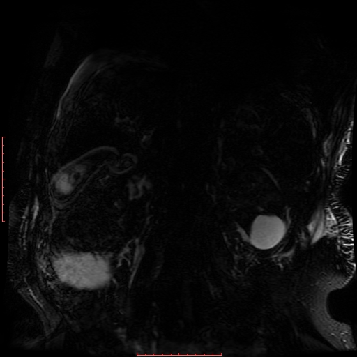 Acute necrotizing pancreatitis (Radiopaedia 28194-28448 Coronal MRCP 13).jpg